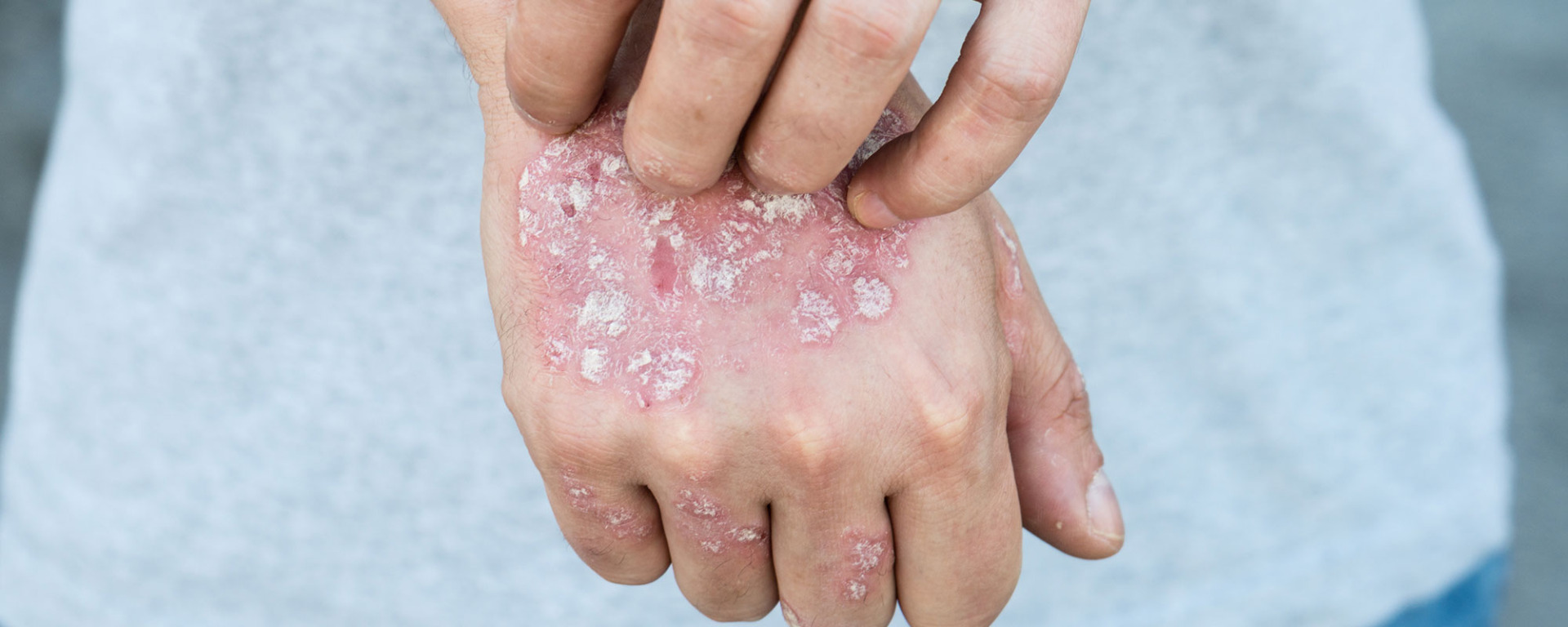 Formen von Schuppenflechte (Psoriasis)